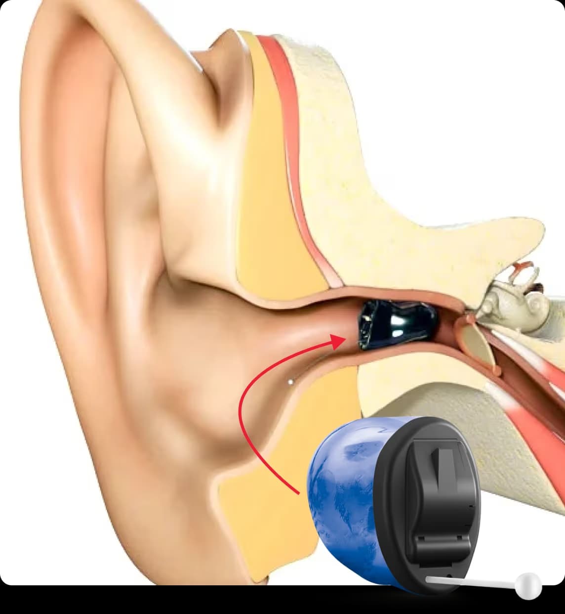 Invisible-in-Canal (IIC) hearing aid