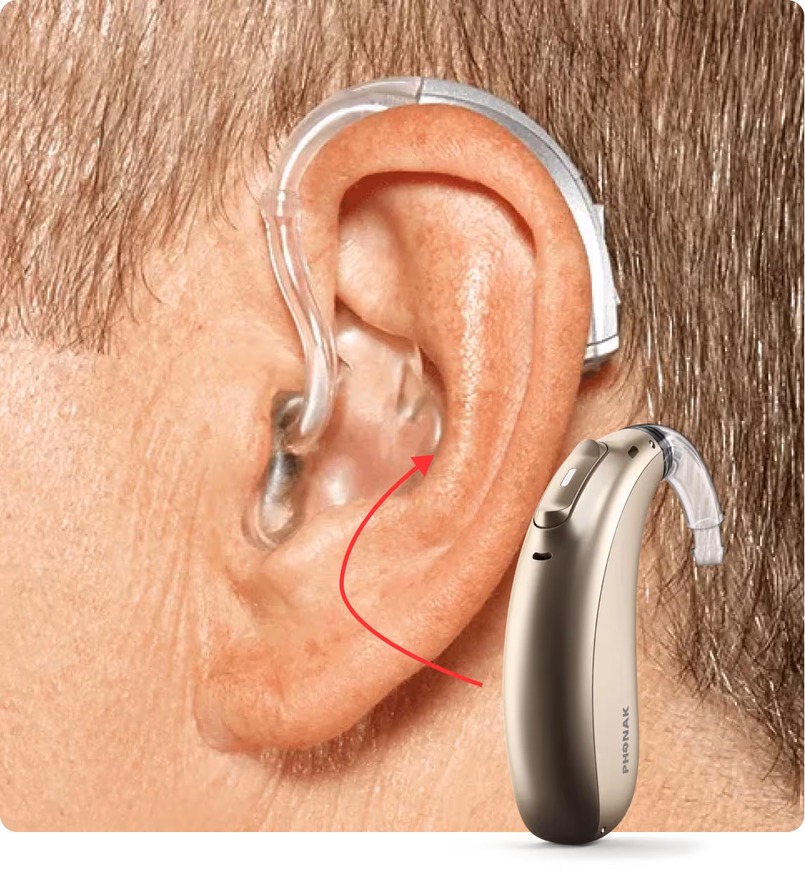 Behind-the-Ear (BTE) hearing aid