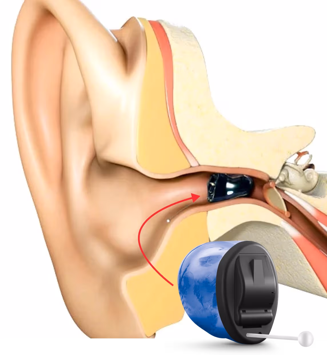 Invisible-in-Canal (IIC) hearing aid